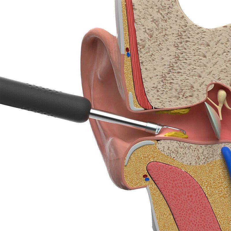 Visual Ear Spoon camera